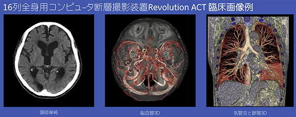 16列全身用コンピュータ断層撮影装置 Revolution ACT臨床画像例